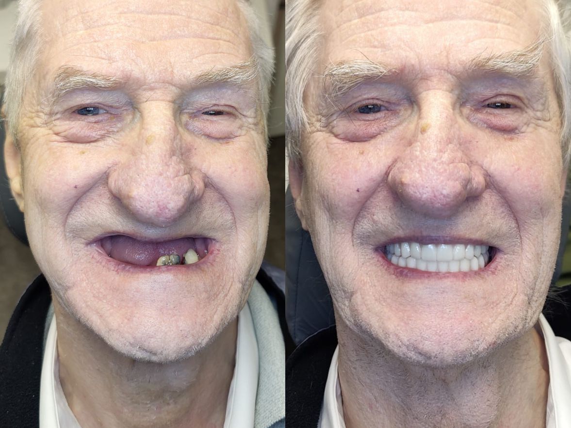 Full mouth reconstruction before and after